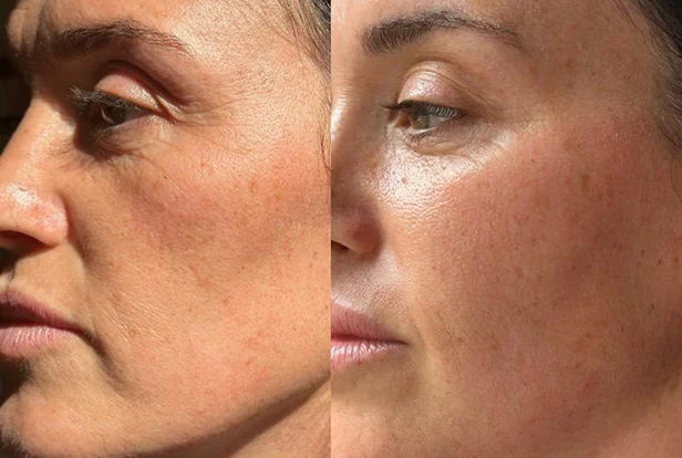 Mesotherapie mesojet Geneve.04.30 copie